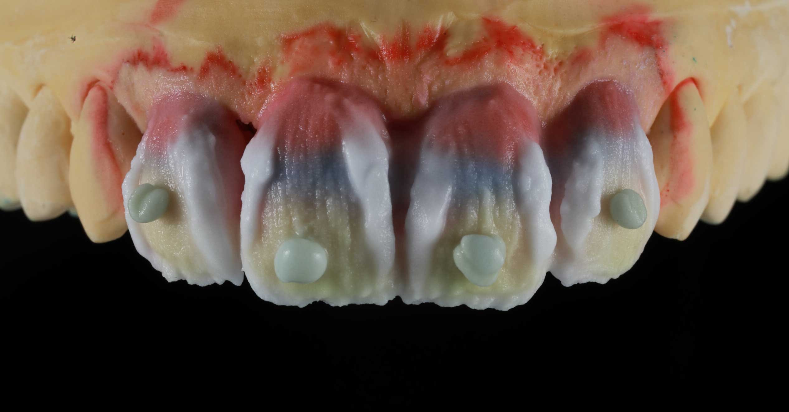 handmade-veneers-wien