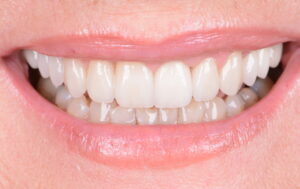 Zahnfleischkorrektur