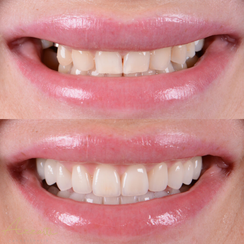 zahnimplantate in wien